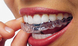 invisalign_