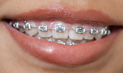 metal braces